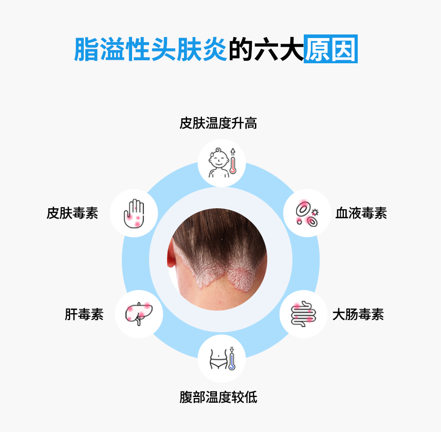 The Six Major Causes of Seborrheic Dermatitis of the scalp