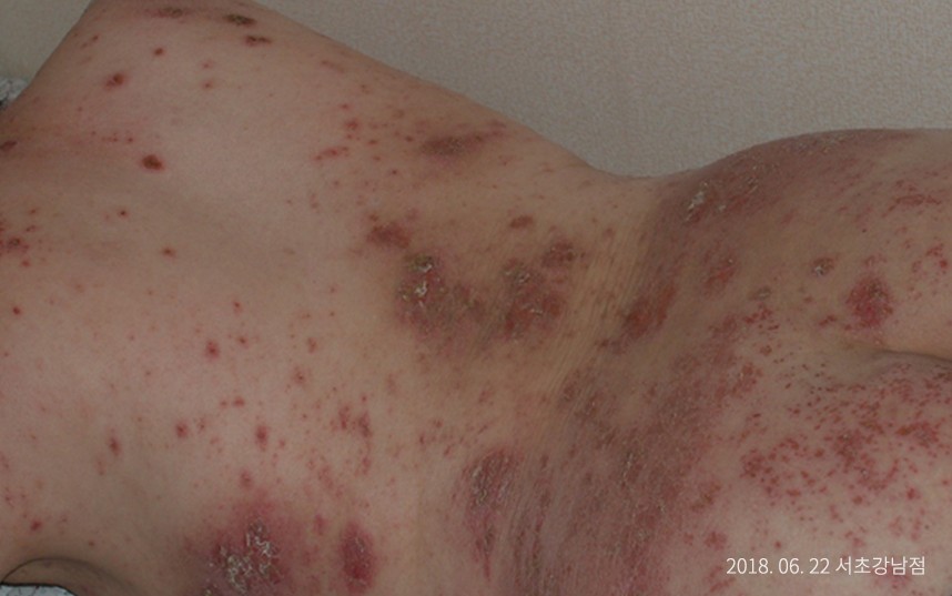 습진 병력