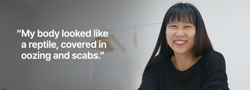 진물 범벅에 딱지까지 앉아 몸이 파충류 같았어요.