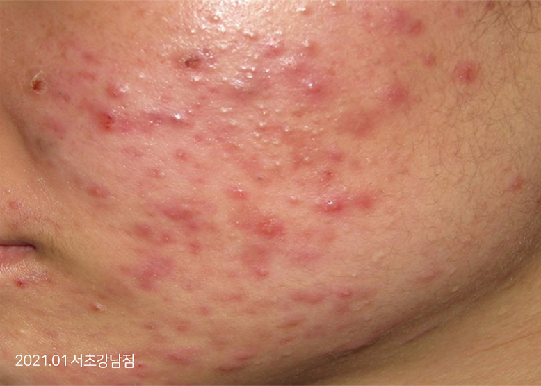 Before Treatment of Acne