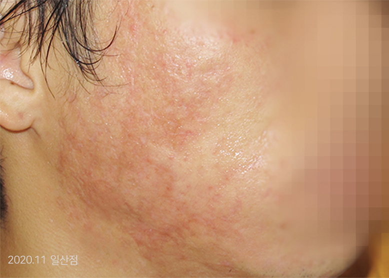 After Treatment of Acne