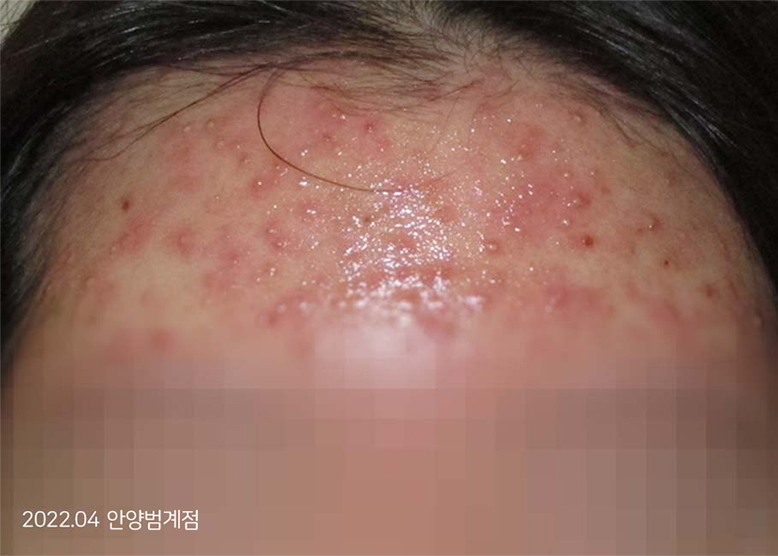 Before Treatment of Acne