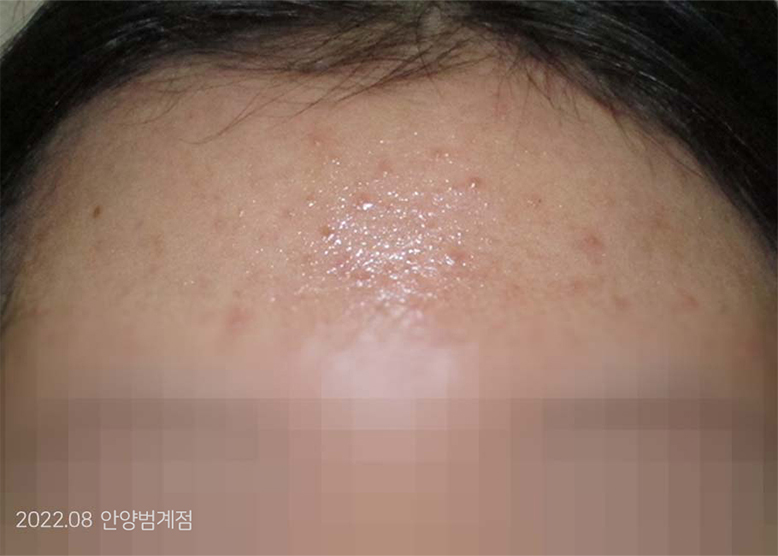 After Treatment of Acne