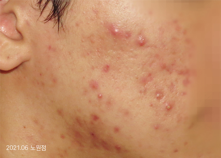 Before Treatment of Acne