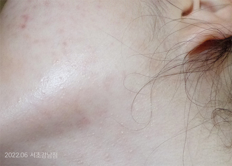 After Treatment of Acne