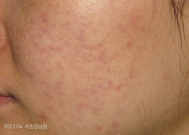 After Treatment of Acne