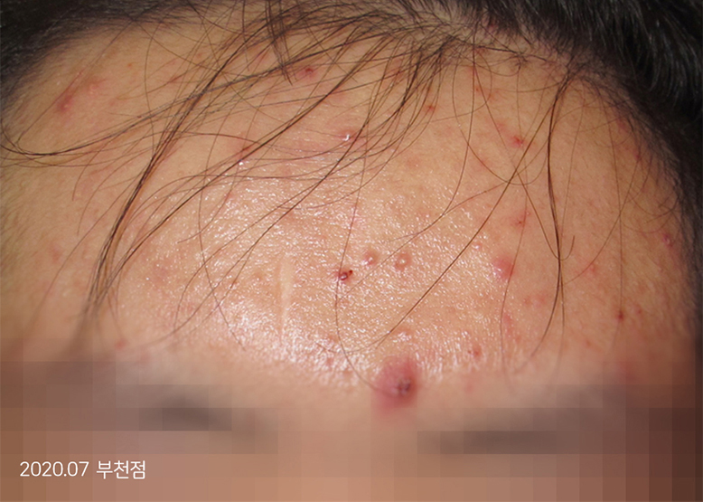Before Treatment of Acne