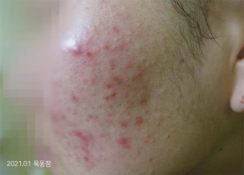 Before Treatment of Acne