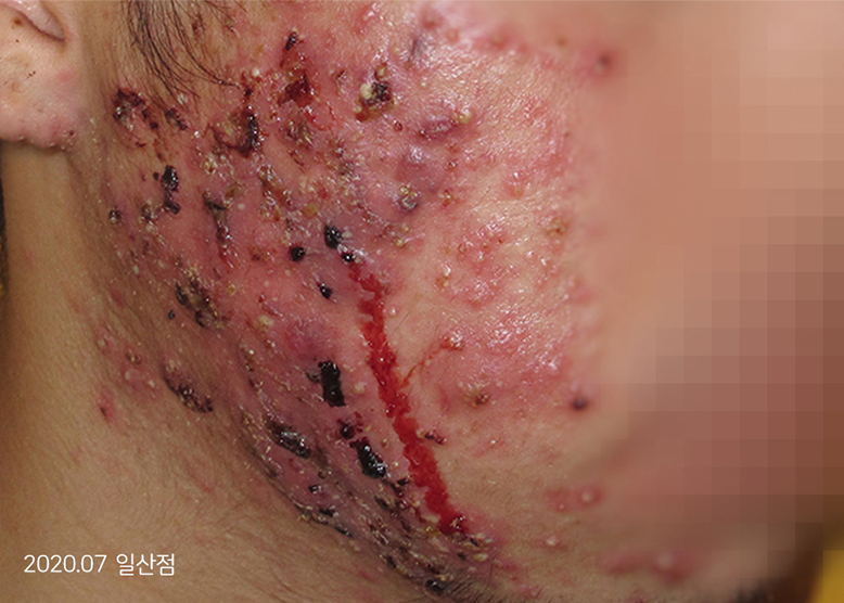 Before Treatment of Acne