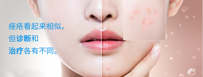 Acne may look similar, but have different diagnoses and treatments!