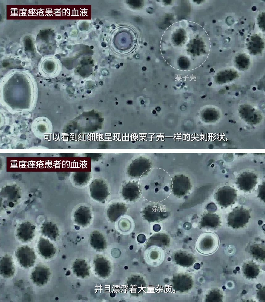 Blood of a patient with severe acne 
