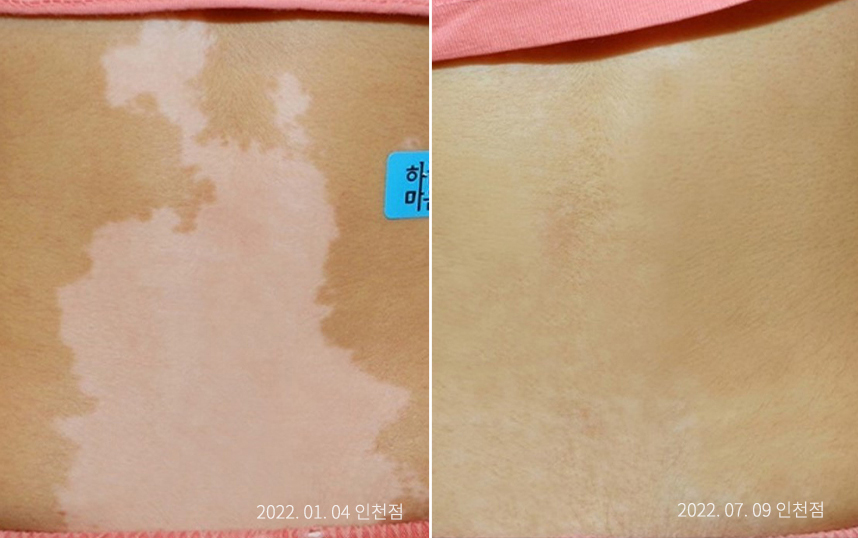백반증 병력
