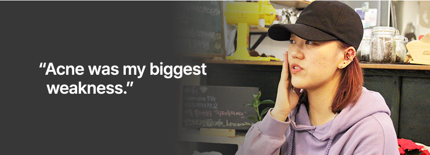 Acne was my biggest weakness.