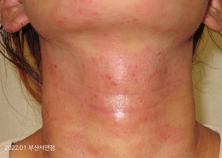 Before Treatment of Urticaria