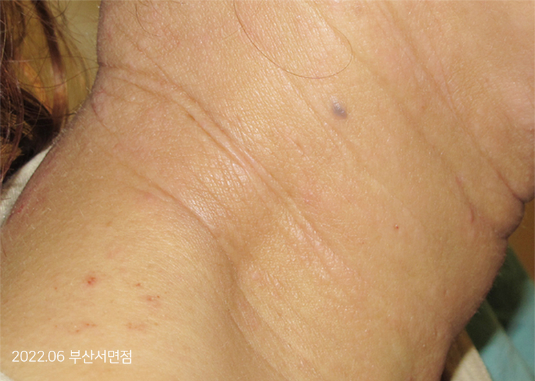 After Treatment of Urticaria