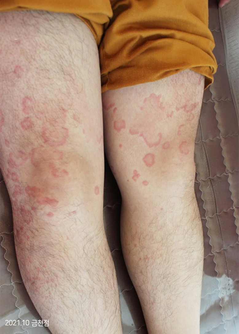 Before Treatment of Urticaria