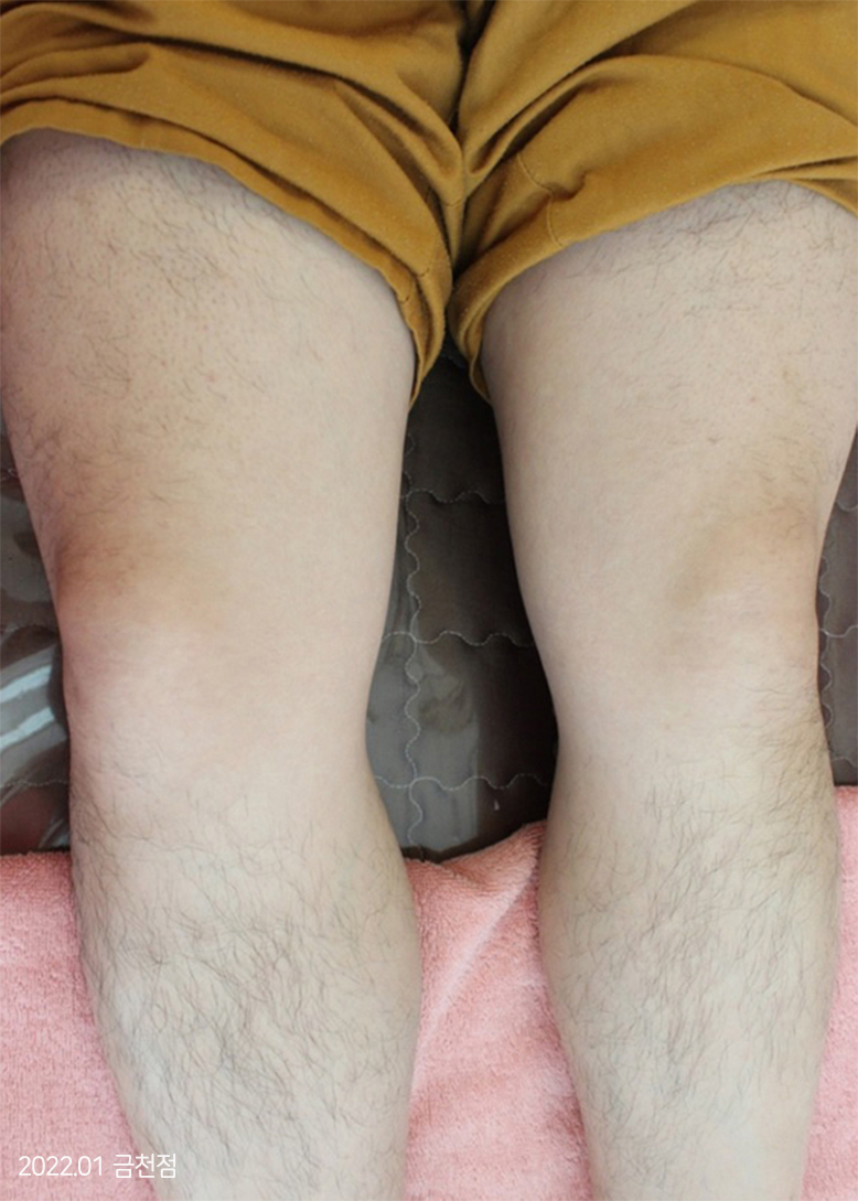 After Treatment of Urticaria