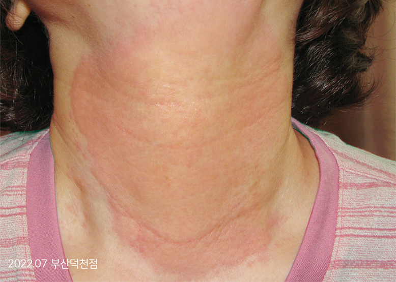 Before Treatment of Urticaria