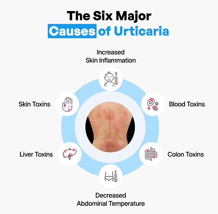 The Six Major Causes of Urticaria