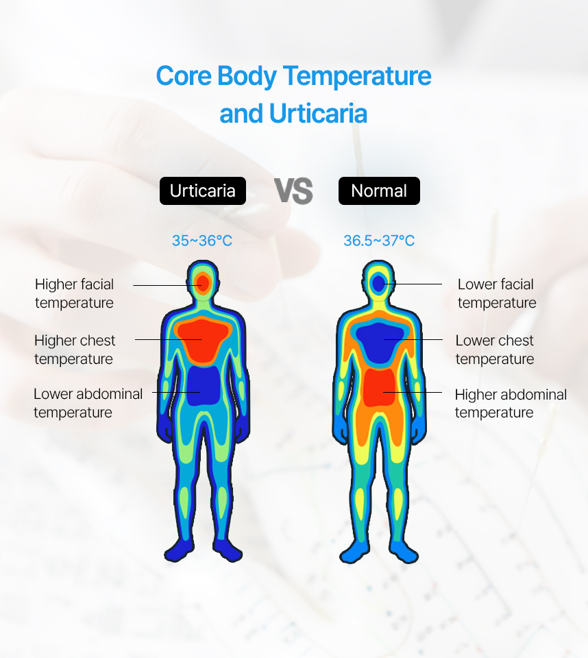 Core Body Temperatureand Urticaria