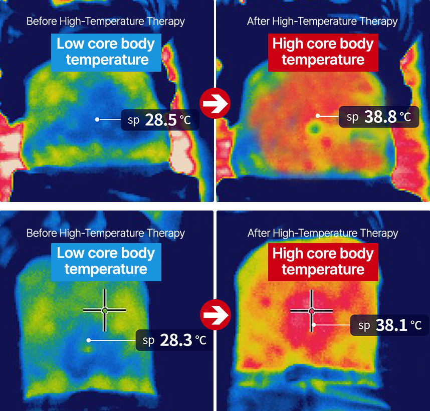 High-Frequency Thermal Therapy