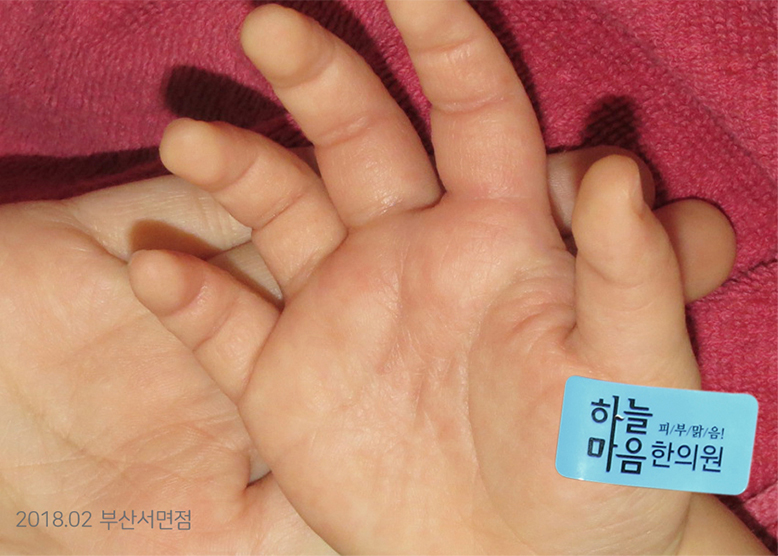 After Treatment of Dyshidrotic Eczema