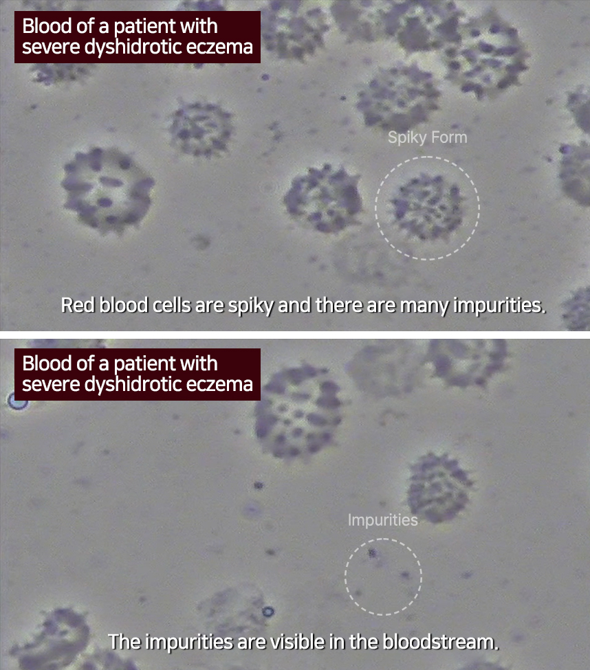 Blood of a patient with severe dyshidrotic eczema