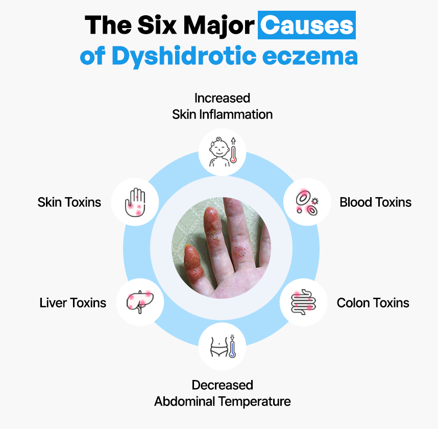 The Six Major Causes of Dyshidrotic Eczema