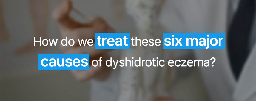 How do we treat these six major causes of dyshidrotic eczema? 