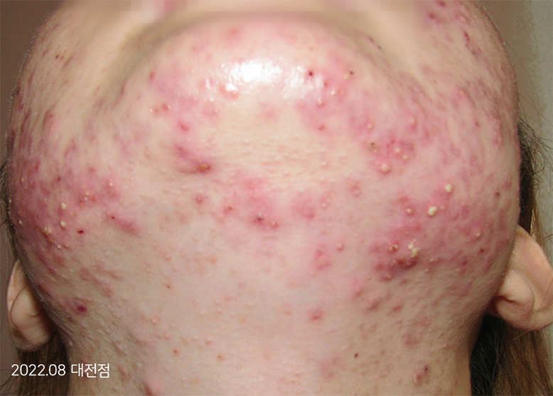 Before Treatment of Seborrheic Dermatitis