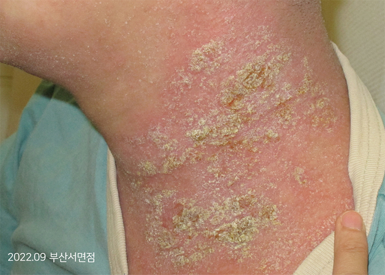 Before Treatment of Seborrheic Dermatitis