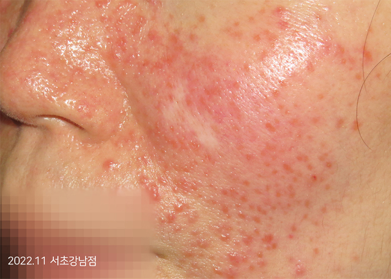 Before Treatment of Seborrheic Dermatitis