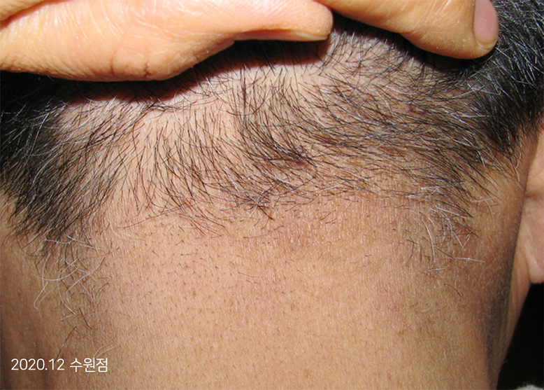 After Treatment of Seborrheic Dermatitis