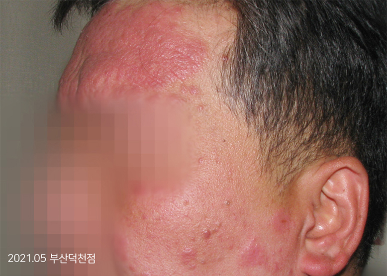 Before Treatment of Seborrheic Dermatitis