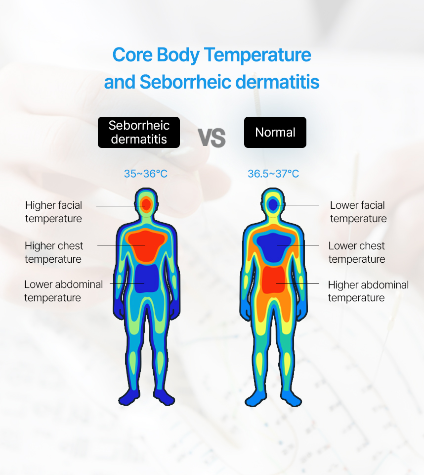 Core Body Temperatureand Seborrheic Dermatitis