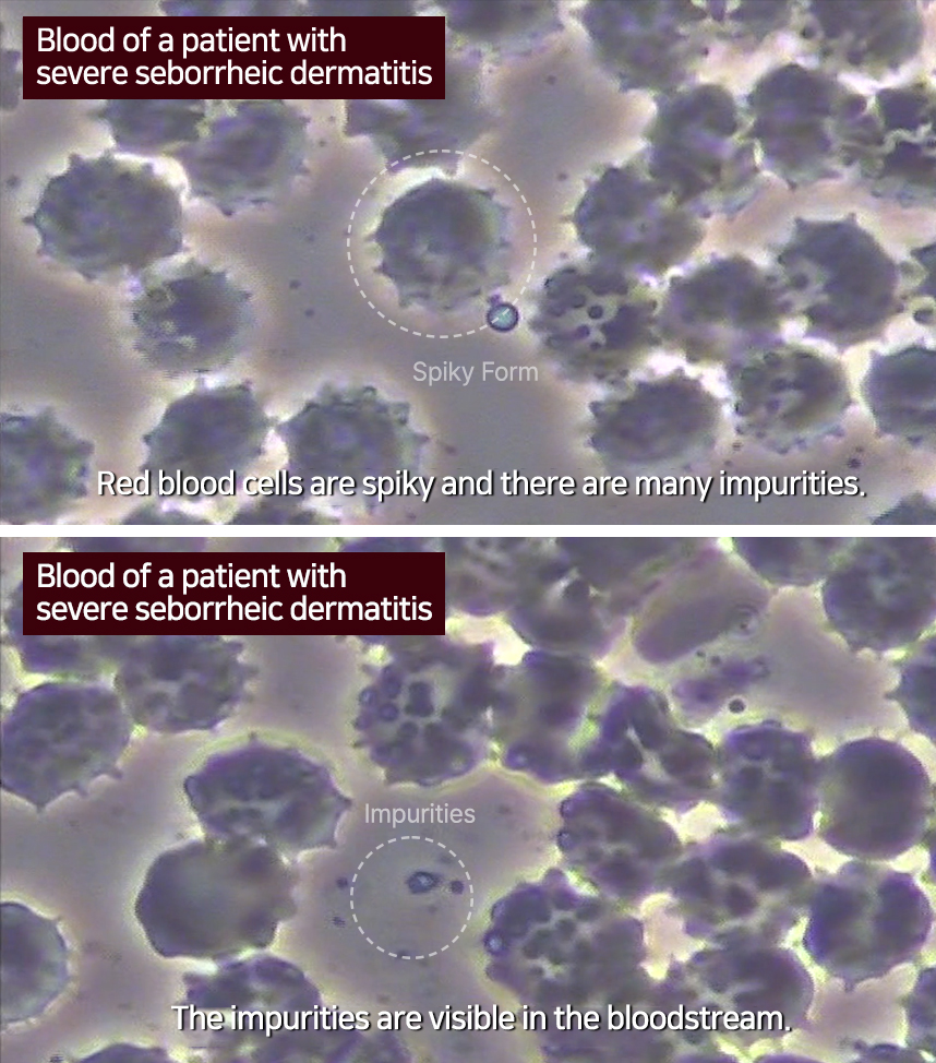 Blood of a patient with severe seborrheic dermatitis