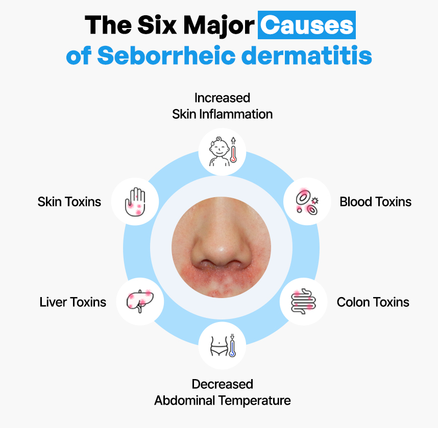 The Six Major Causes of Seborrheic Dermatitis
