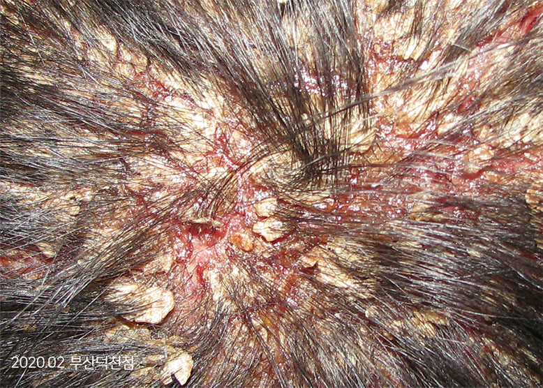 Before Treatment of Seborrheic Dermatitis of the scalp