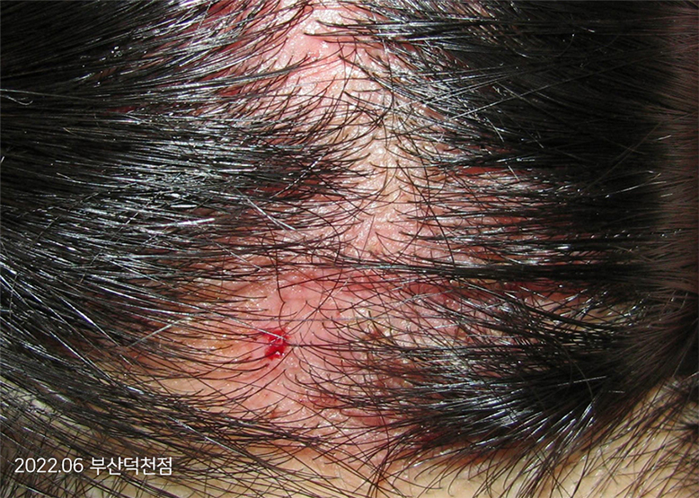 Before Treatment of Seborrheic Dermatitis of the scalp