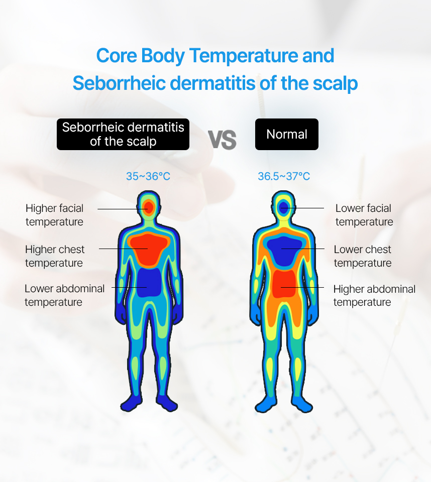 Core Body Temperatureand Seborrheic Dermatitis of the scalp 