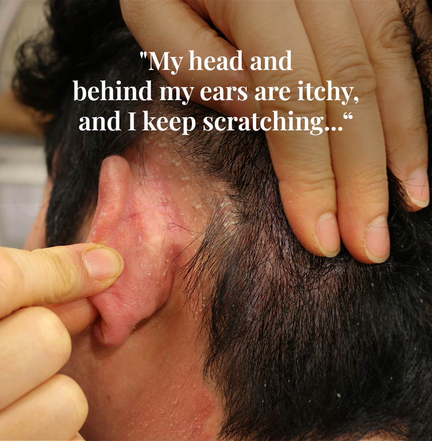 My head and behind my ears are itchy, and I keep scratching...