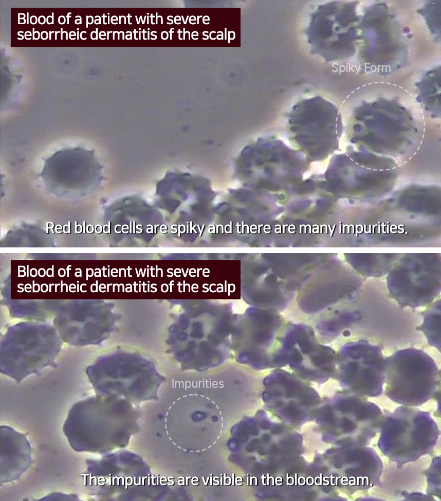 Blood of a patient with severe seborrheic dermatitis of the scalp 
