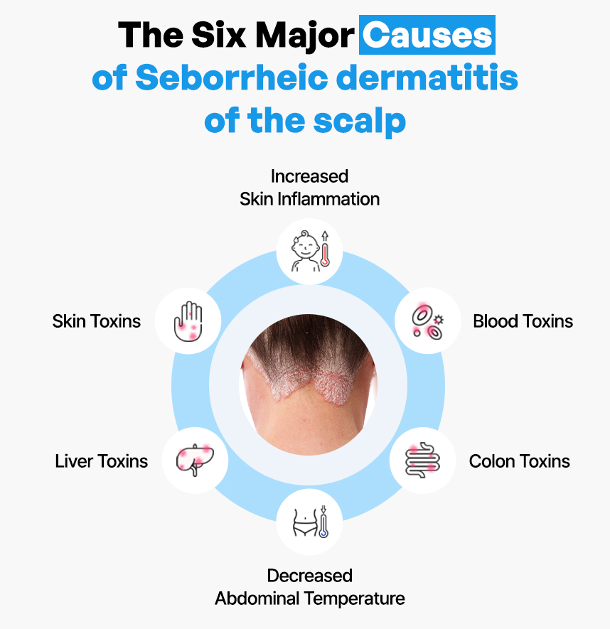 The Six Major Causes of Seborrheic Dermatitis of the scalp