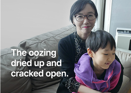 진물이 굳어서 쩍쩍 갈라졌어요.