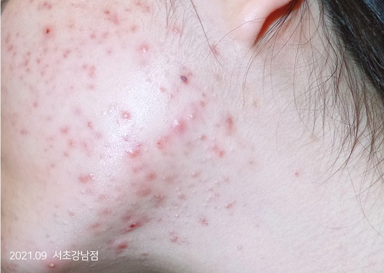 Before Treatment of Acne