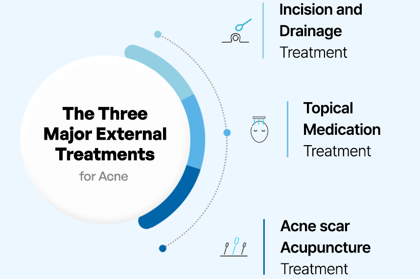 The Three Major External Treatments for Acne