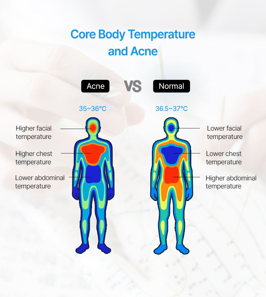 Core Body Temperatureand Acne