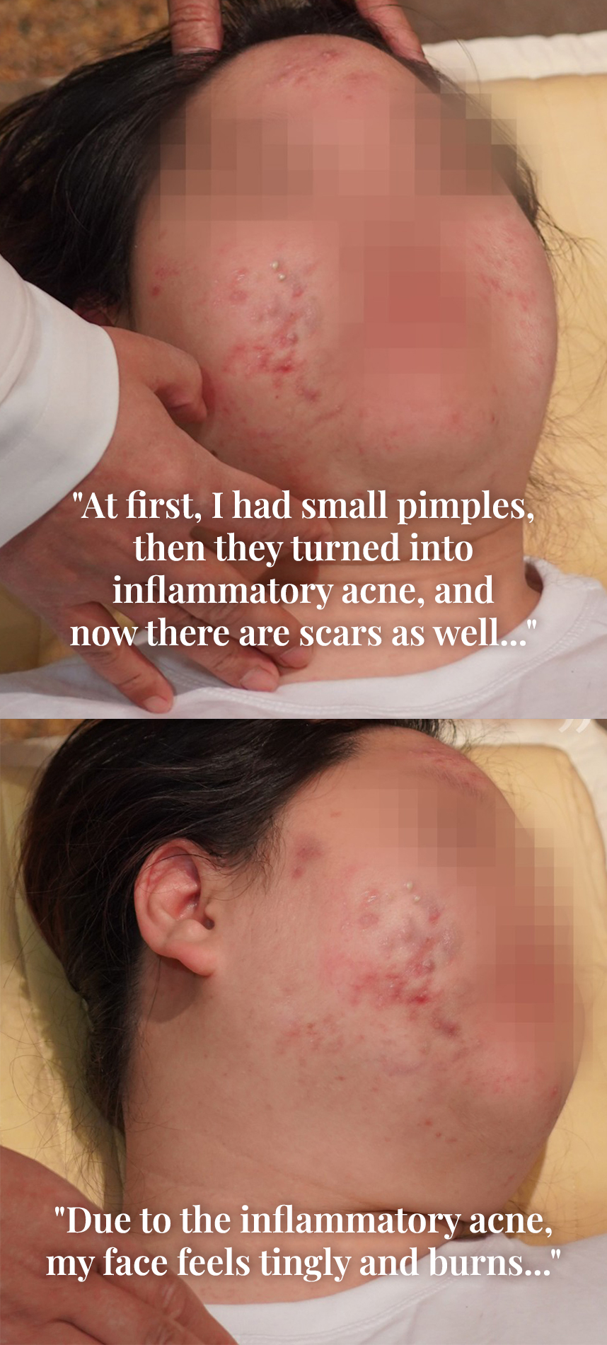 At first, I had small pimples, then they turned into inflammatory acne, and now there are scars as well... Due to the inflammatory acne, my face feels tingly and burns...