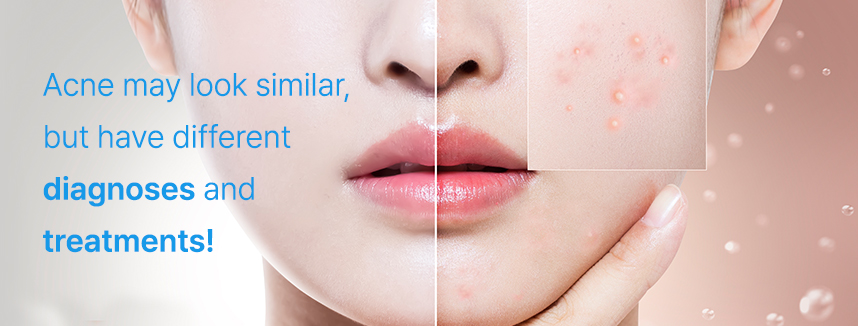 Acne may look similar, but have different diagnoses and treatments!