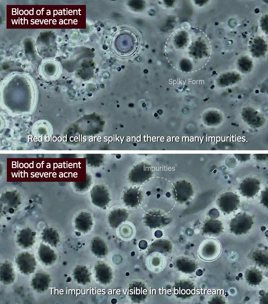 Blood of a patient with severe acne